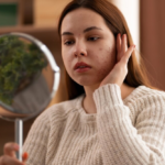 What are the Top 5 Causes of Acne